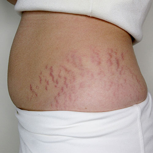 Stretch Marks on Stomach/hips due to pregnancy - before treatment