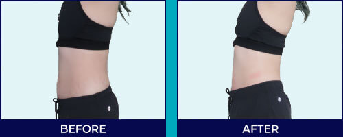 Exilis Body Contouring before after Expressions