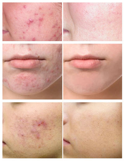 acne removal before after expressions singapore