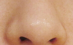 blackheads after