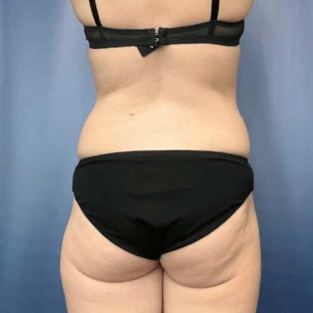 Customized slimming solutions Expressions Before After