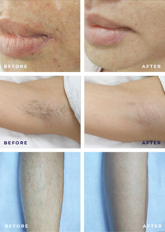 Customized Hair Removal Luminn by Expressions