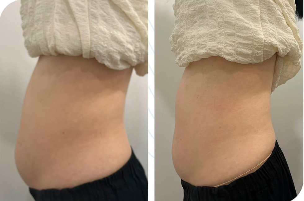 thermowave before and after